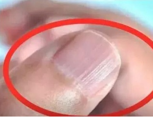 香蕉视频APP色版廠家分析手指甲有豎紋的根本原因 香蕉视频APP色版廠家分析手指甲有豎紋的根本原因